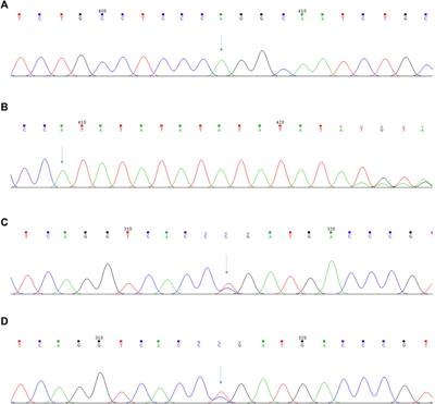 Case report: A rare case of pyruvate kinase deficiency and Crigler-Najjar syndrome type II with a novel pathogenic variant of PKLR and UGT1A1 mutation